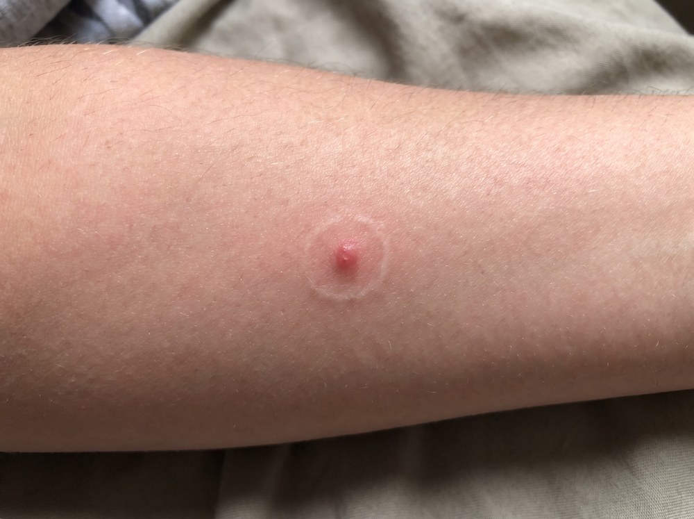 Close-up of a mild green lynx spider bite showing two tiny puncture marks surrounded by faint pink redness